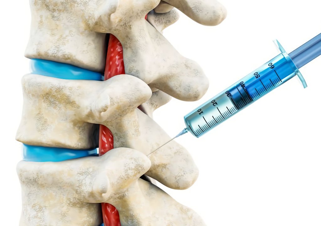 Facet-Joint-Injections-in-Gilbert-AZ Facet Joint Injections in Gilbert AZ