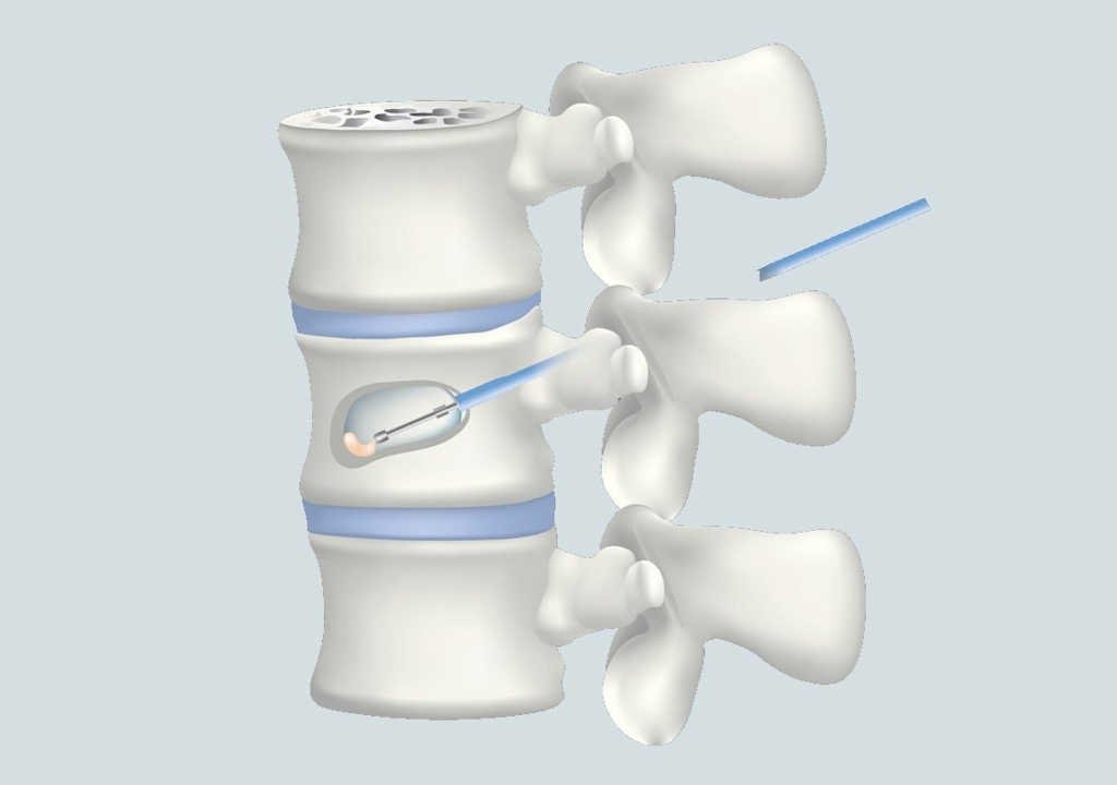 Kyphoplasty-Services-In-Gilbert Kyphoplasty Services In Gilbert