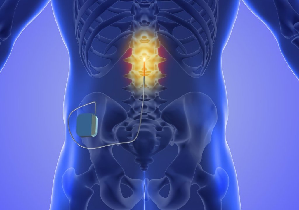 Spinal-Cord-Stimulation Spinal Cord Stimulation in Gilbert AZ