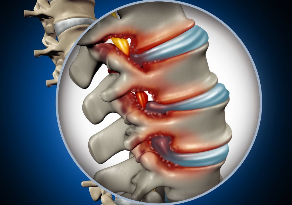Spinal-Stenosis-Pain-Condition Spinal Stenosis Pain Condition In Gilbert