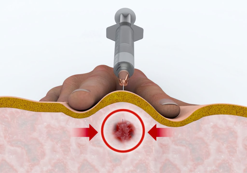 Trigger-point-Injections-in-Gilbert-AZ Trigger point Injections in Gilbert AZ