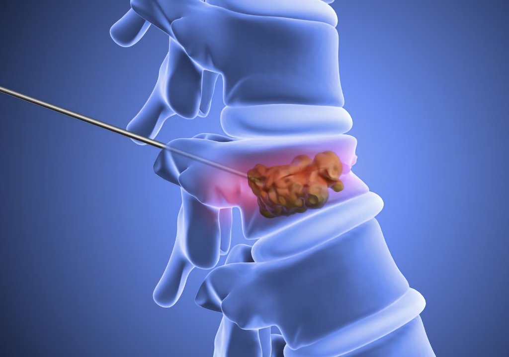 Vertebroplasty-Treatment-in-Gilbert-AZ Vertebroplasty Treatment in Gilbert AZ